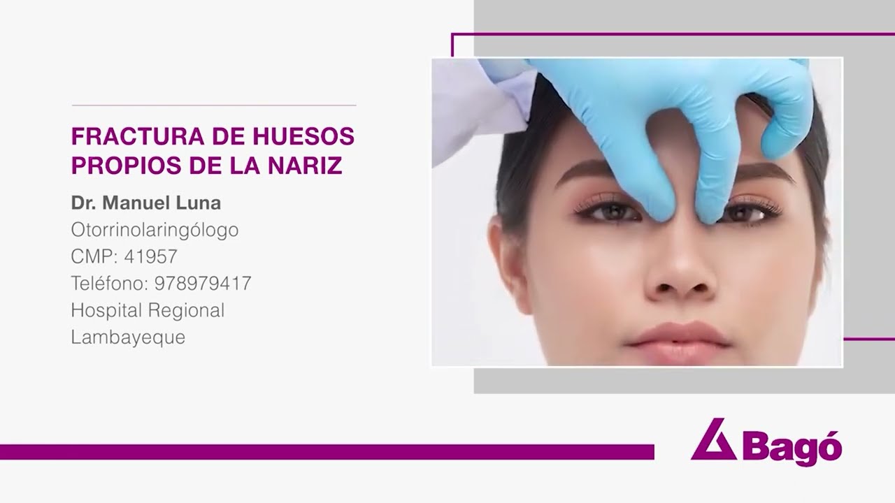 fractura de huesos propios sin desplazamiento