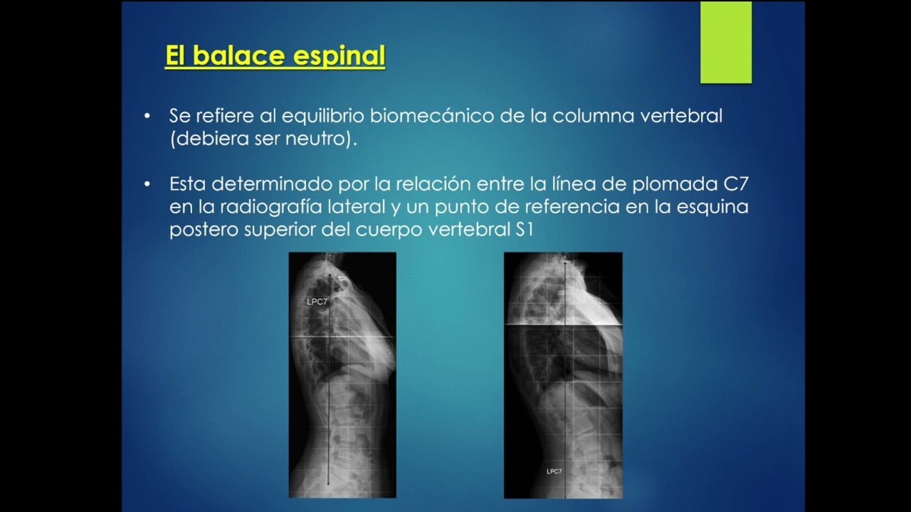 actualizacion de la evaluacion radiologica de la escoliosis