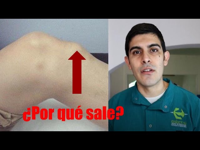 bulto en la parte delantera de la rodilla