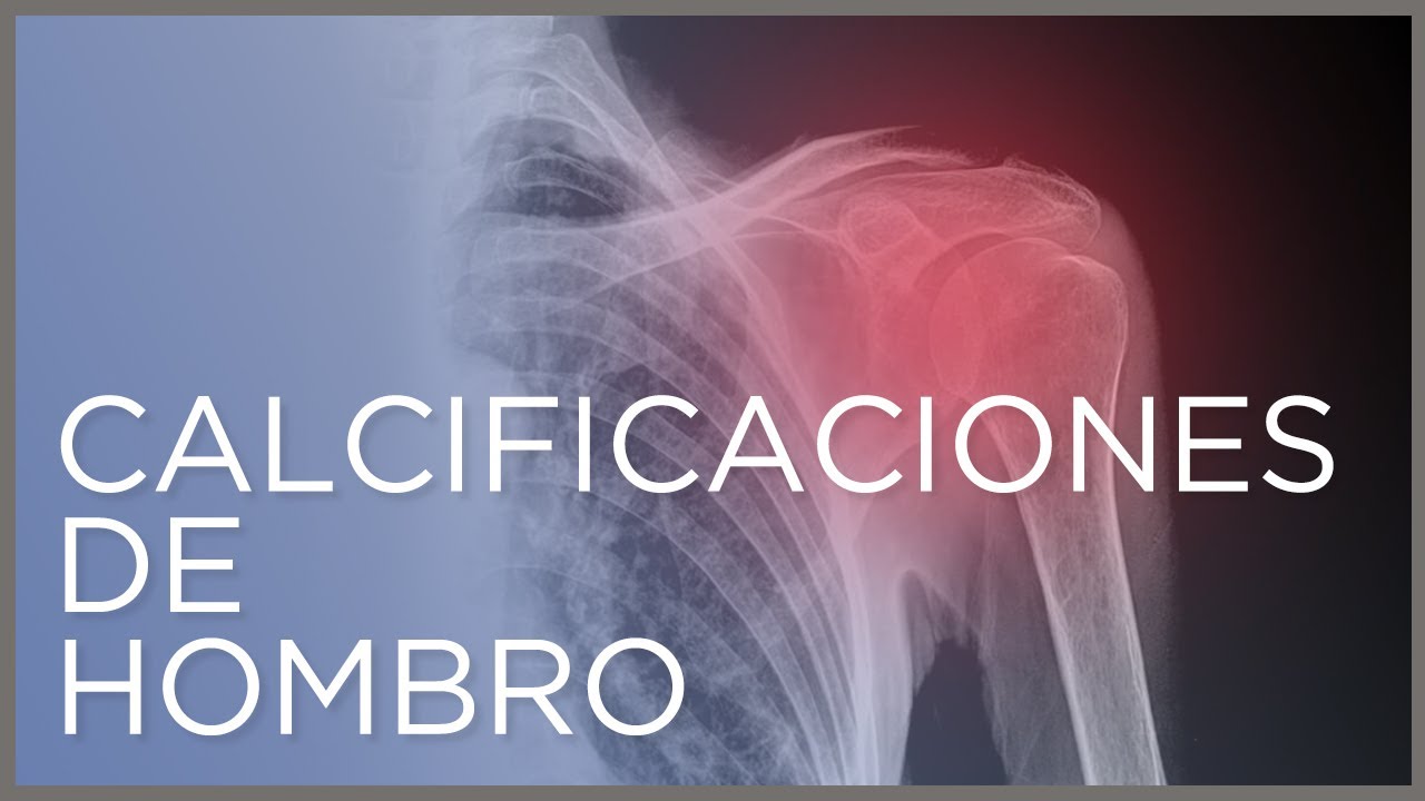 calcificacion en el hombro enfermedad profesional