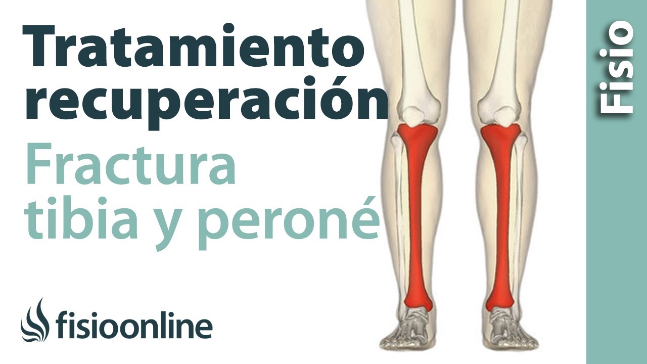 casos de invalidez por rotura de tibia y peroné