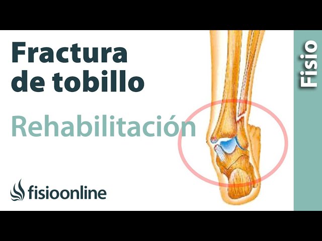 como mantenerse en forma con un tobillo fracturado