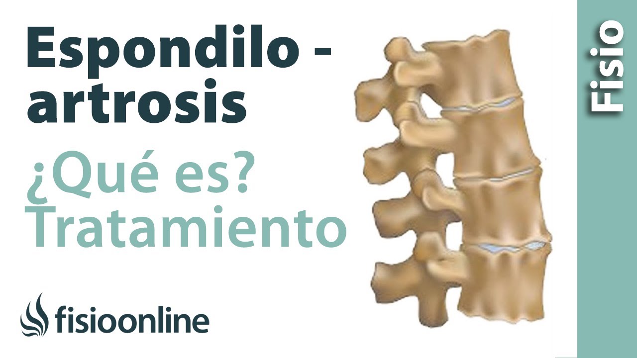 como se cura la espondilosis lumbar