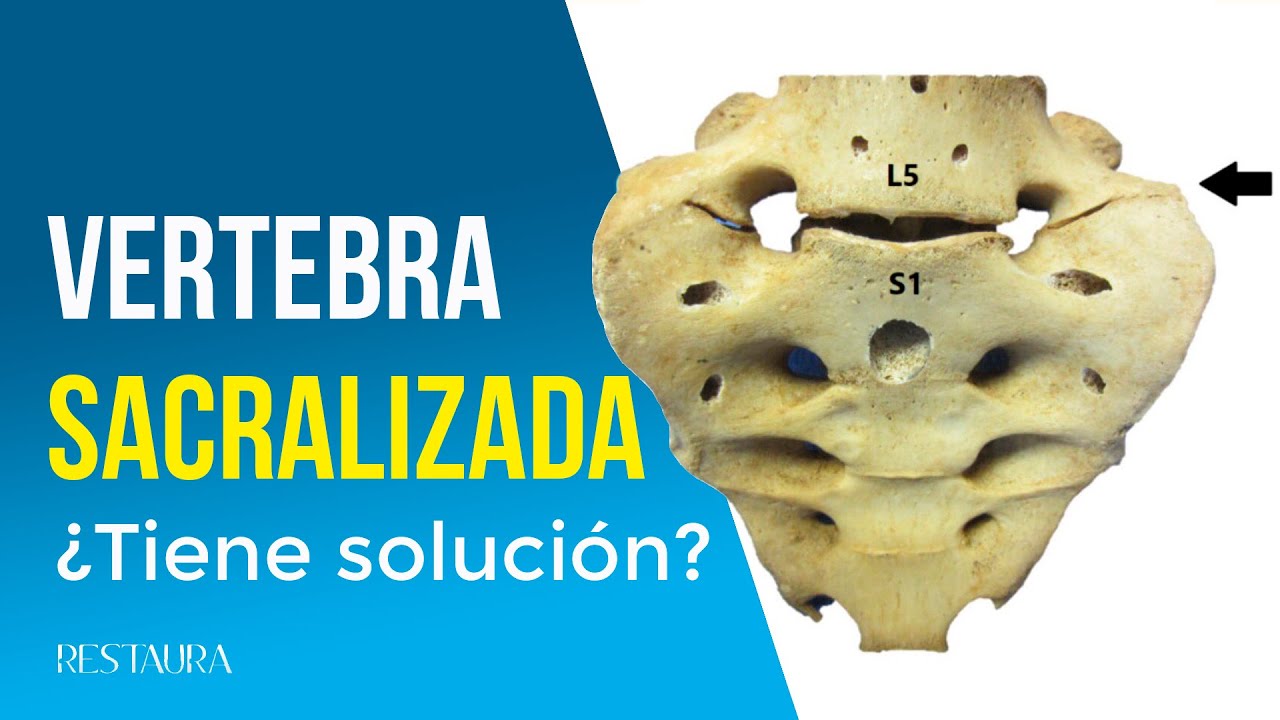 defecto de fusion del arco posterior s1