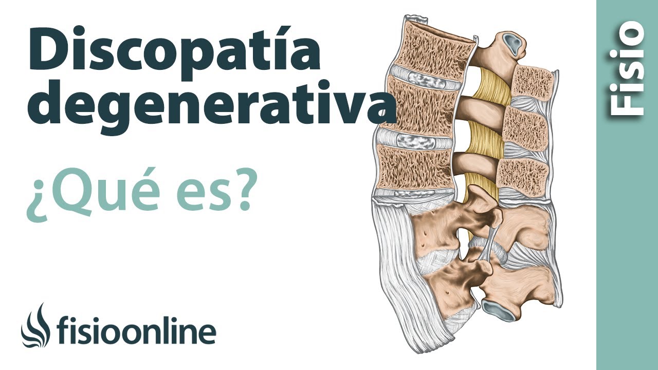discopatia degenerativa l5 s1 que es