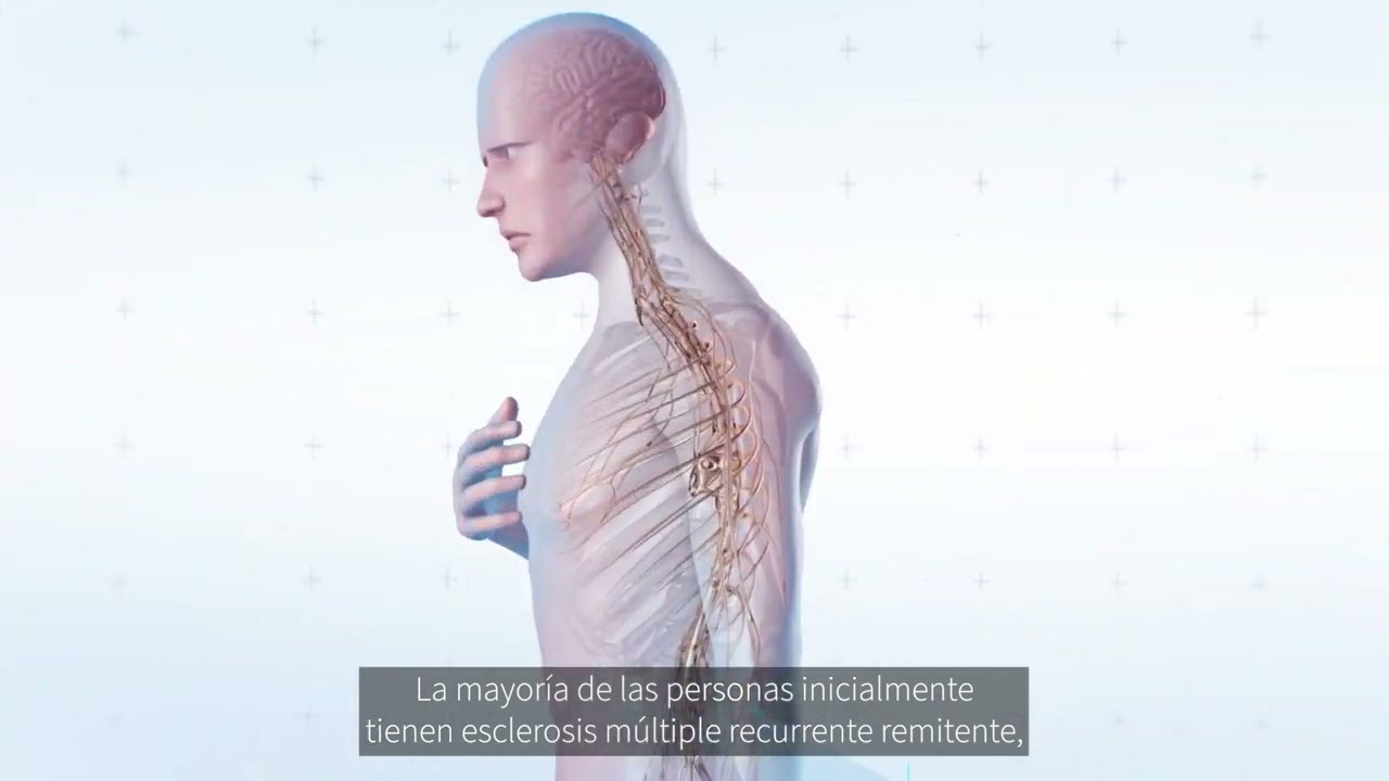 enfermedad de los huesos esclerosis multiple
