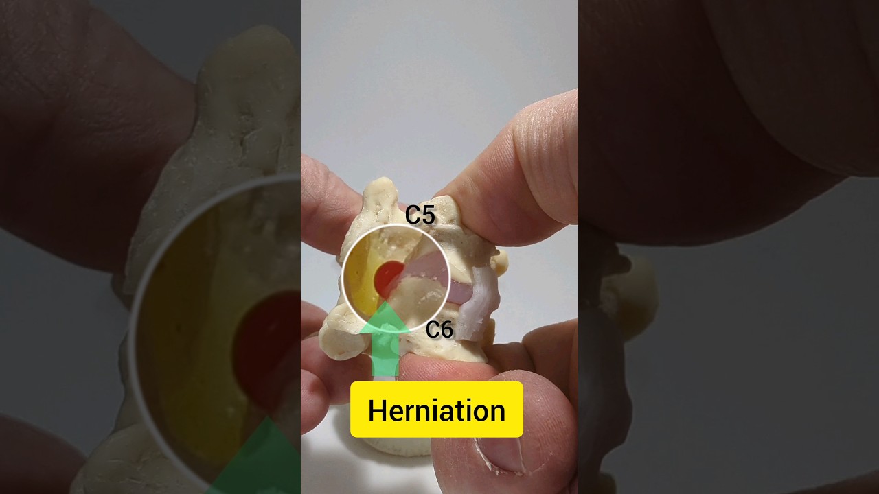 hernia discal cervical c5 c6 c6 c7