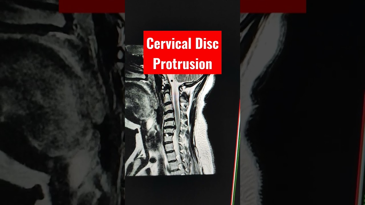 hernia discal foraminal derecha c5 c6