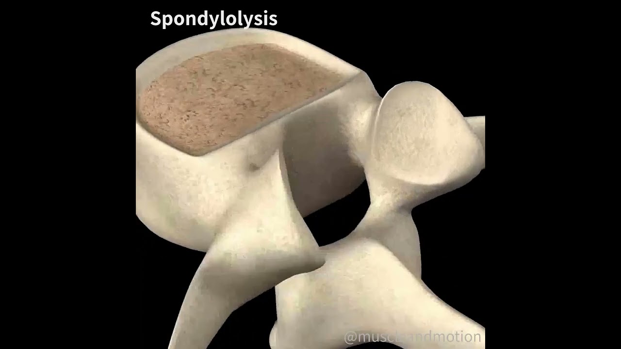 lisis bilateral de la pars interarticularis de l5