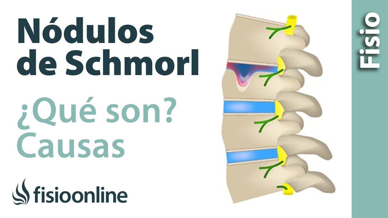 que son los nodulos de schmorl en columna