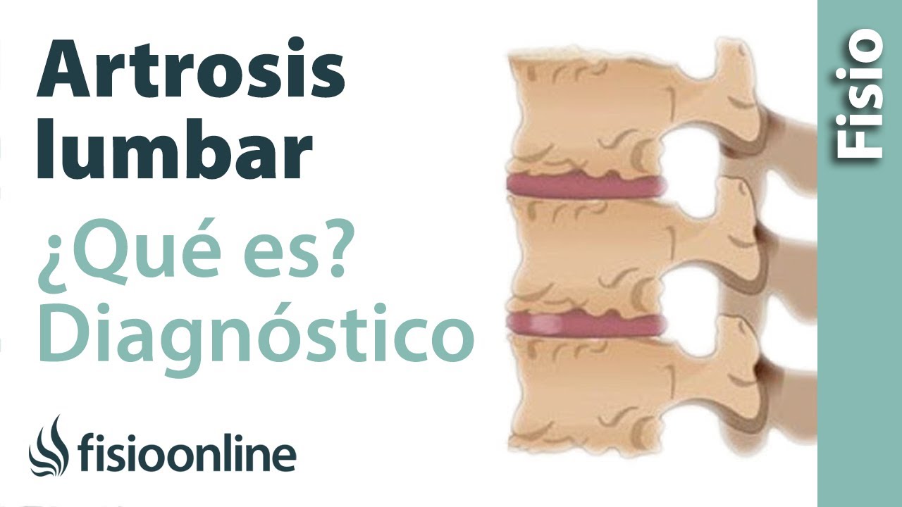 radiografia de columna vertebral con artrosis