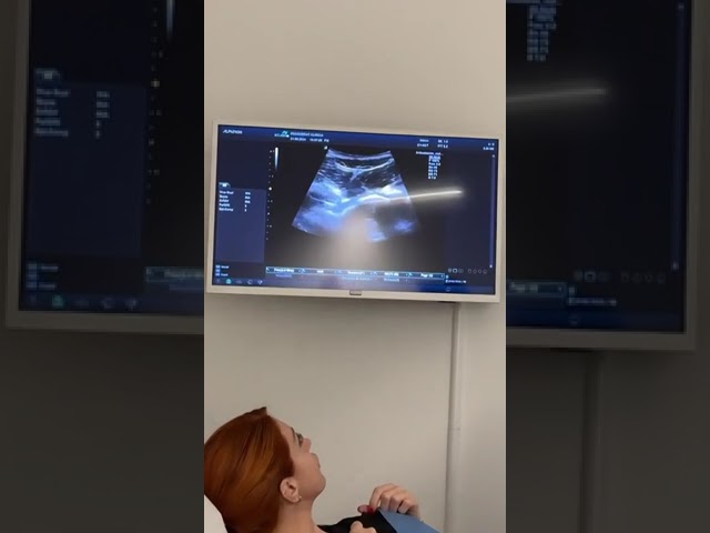 rotura del labrum de la cadera