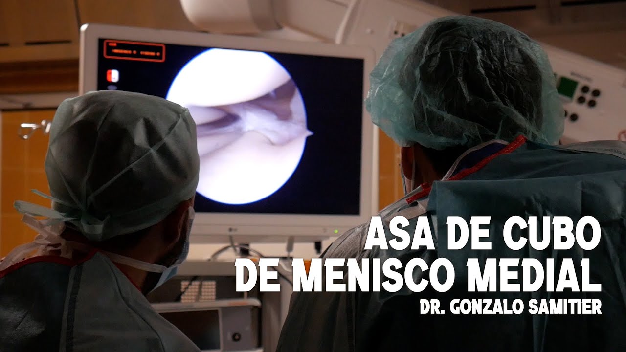rotura en asa de cubo del menisco interno