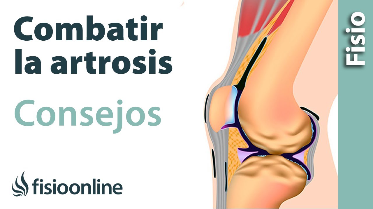 sirve la fisioterapia para la artrosis