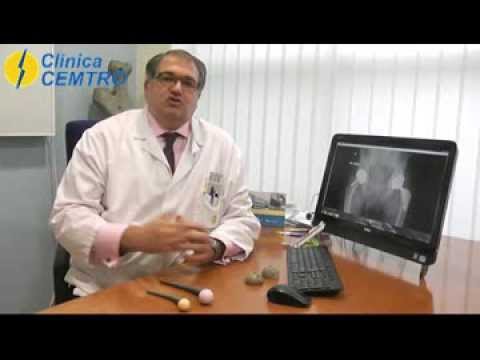 tipos de protesis de cadera ceramica