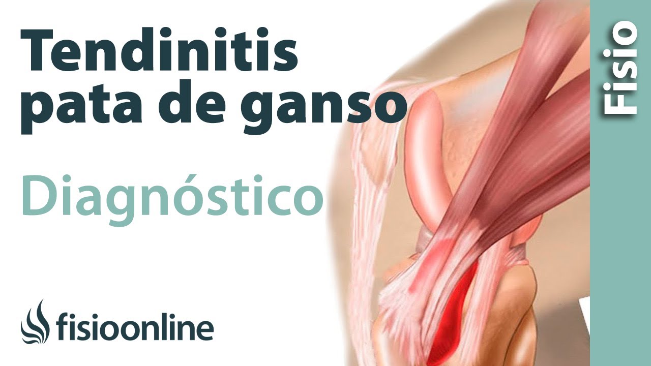 baja laboral por tendinitis pata de ganso