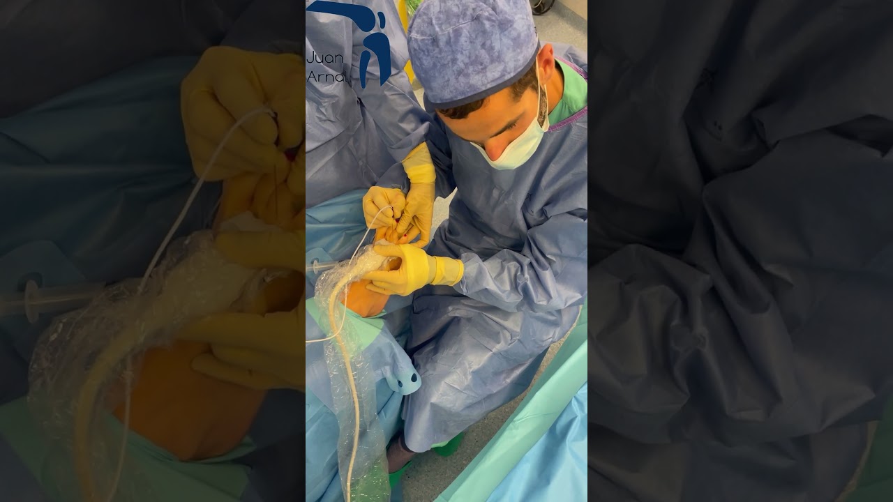 efectos secundarios operacion neuroma de morton