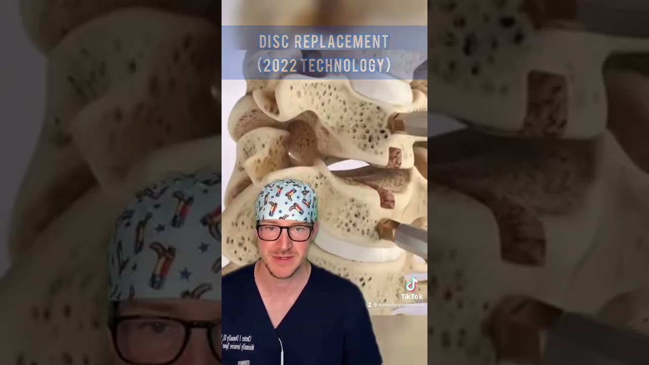 hernia discal cervical con compresion medular