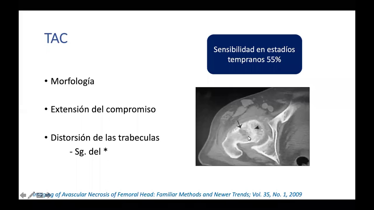 necrosis avascular de la cabeza femoral