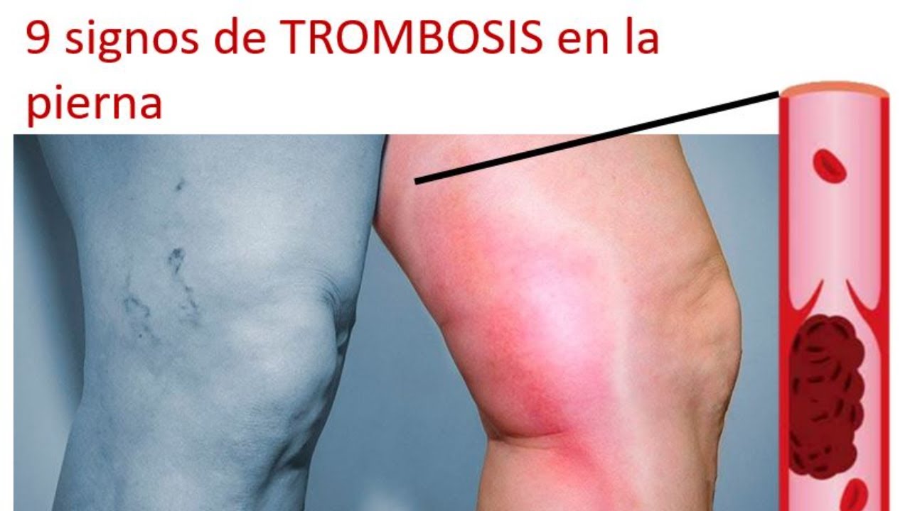 porque salen hundimientos en las piernas