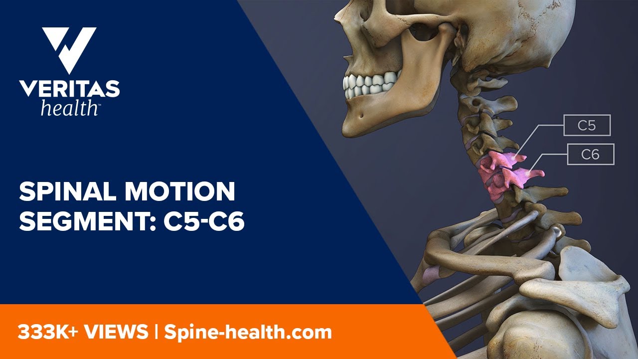 protrusion disco osteofitaria posterior c5 c6