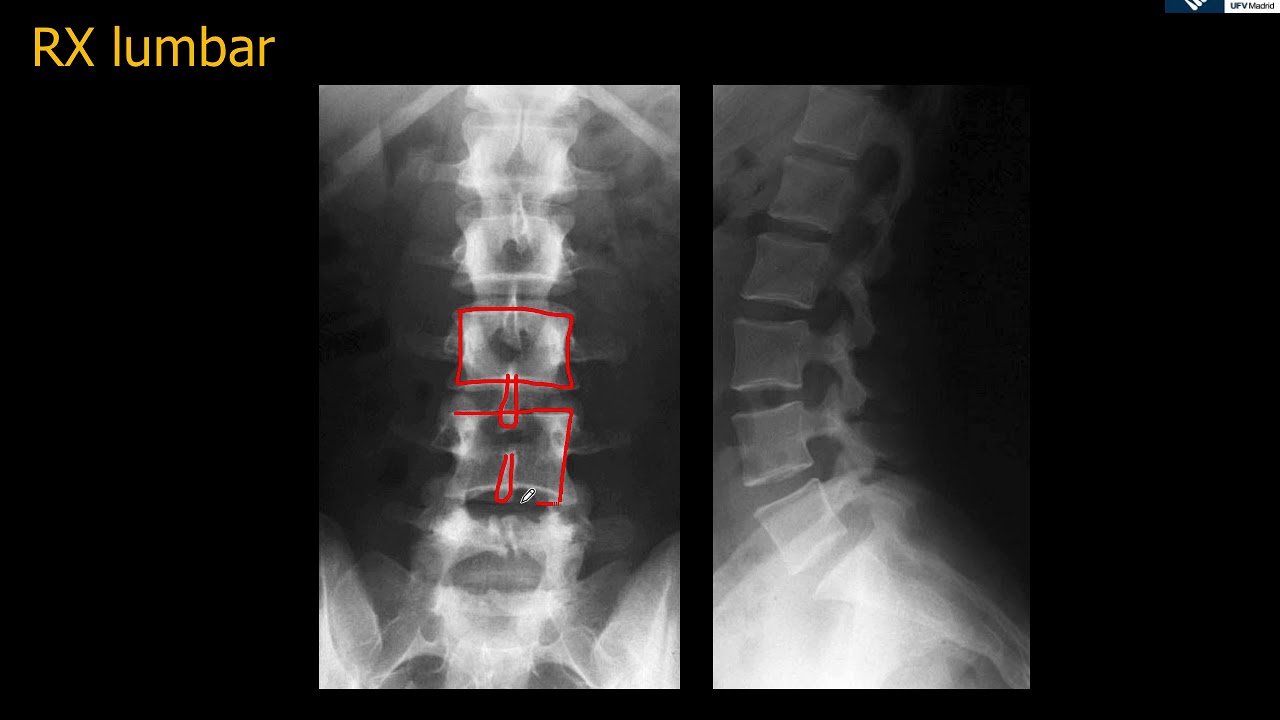 que se ve en una radiografia de espalda