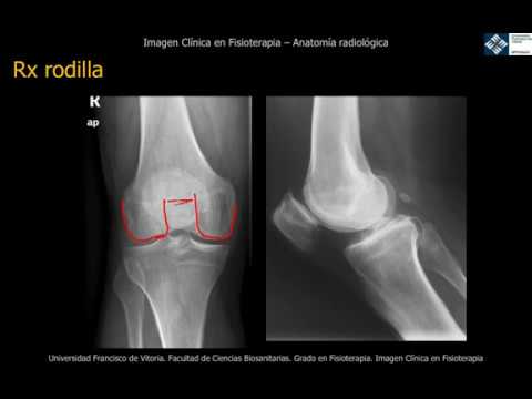 que se ve en una radiografia de rodilla