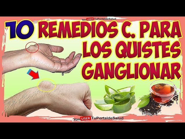 quiste sinovial dedo mano remedios caseros