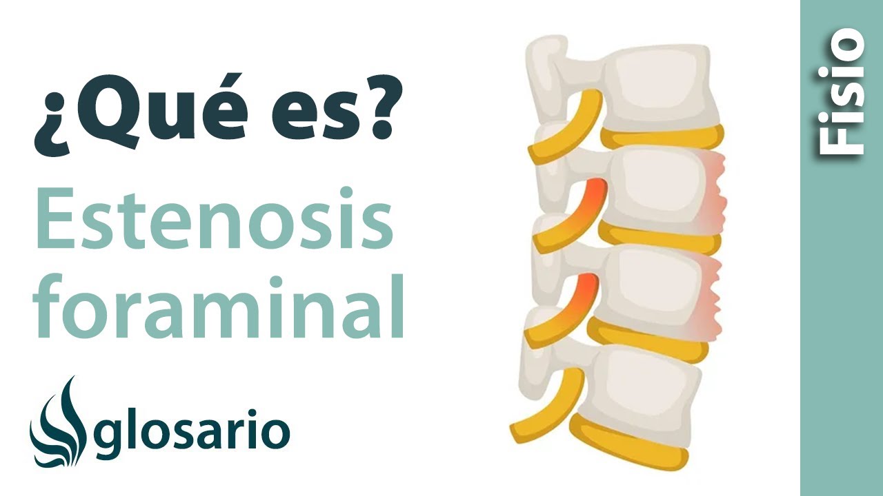 se debe trabajar con estenosis foraminal