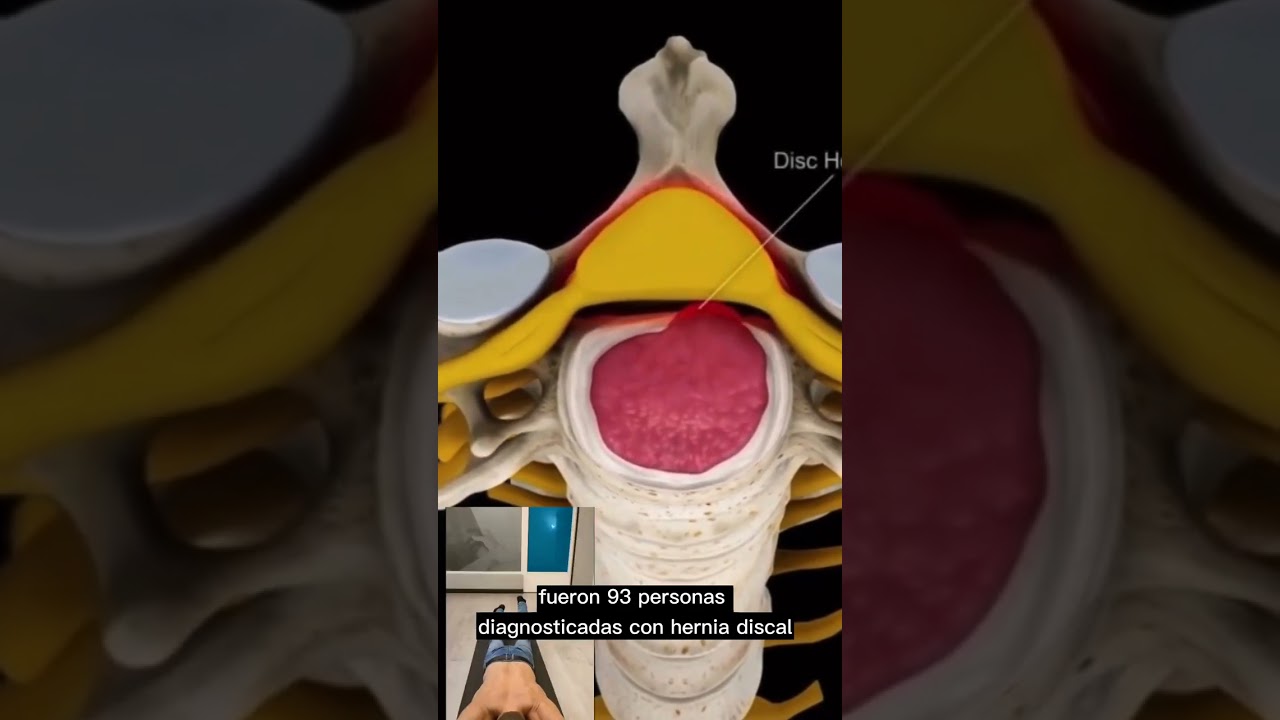 se puede palpar una hernia discal