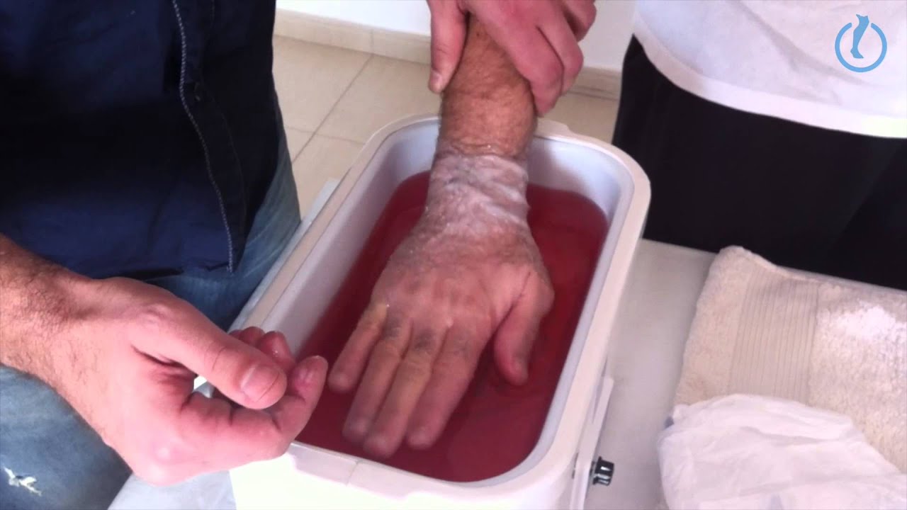 tratamiento con parafina para manos con artritis