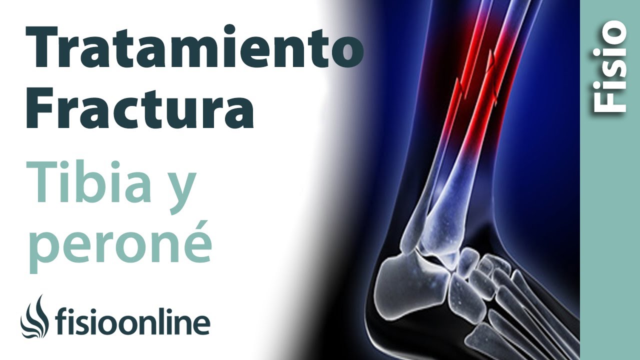 tratamiento para fractura de tibia y perone