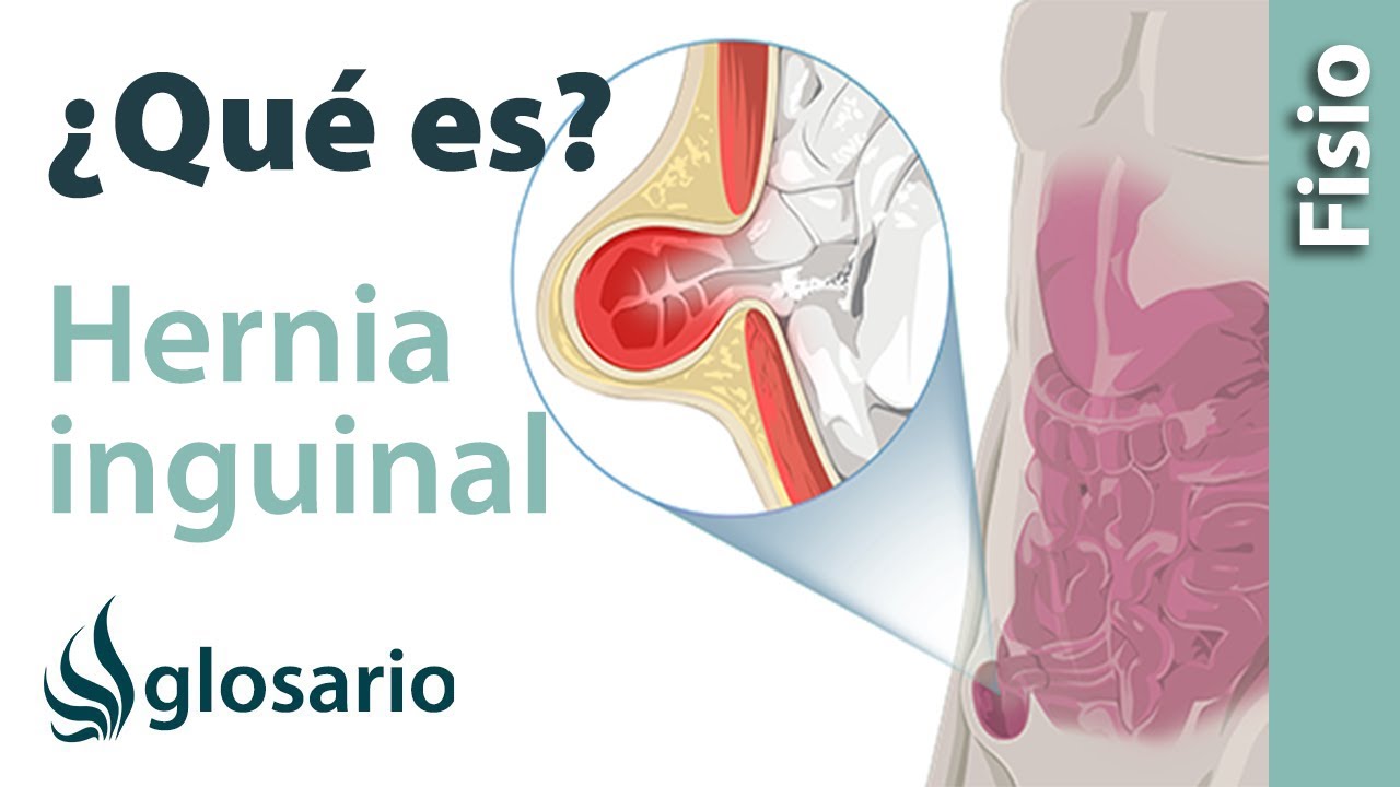 una hernia inguinal puede afectar la prostata