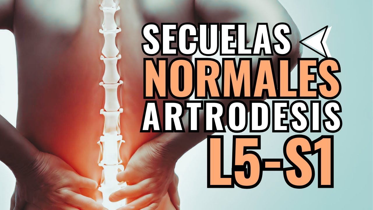 artrodesis lumbar l4 l5 s1 secuelas