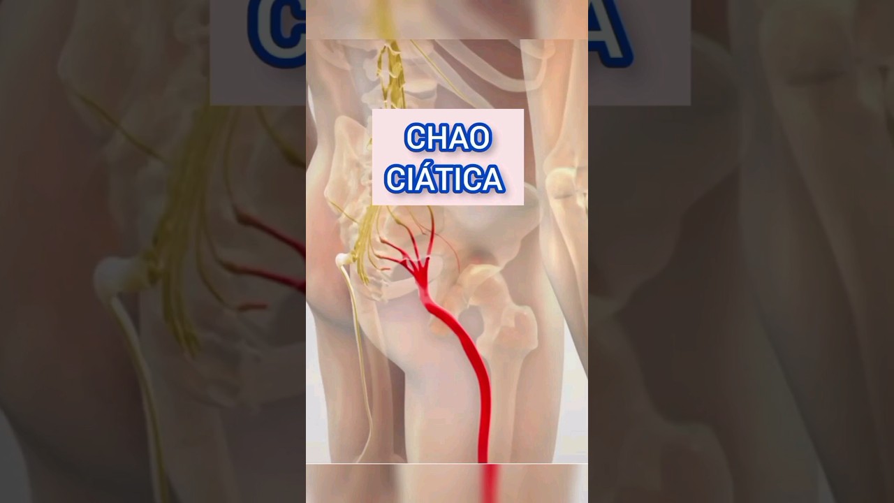 como tratar la ciatica con fisioterapia