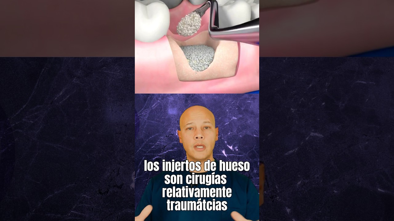 cuanto tarda un injerto de hueso en soldar