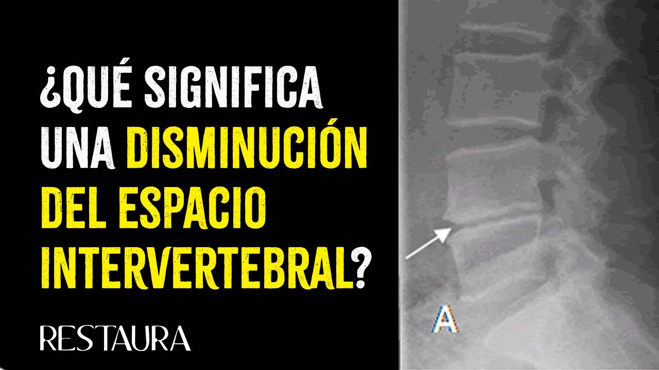 disminucion del espacio intervertebral l5 s1 tratamiento