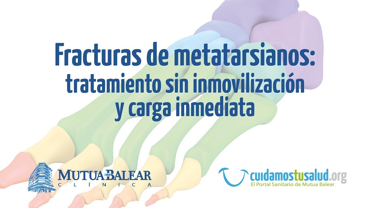 fractura de 2 y 3 metatarsiano