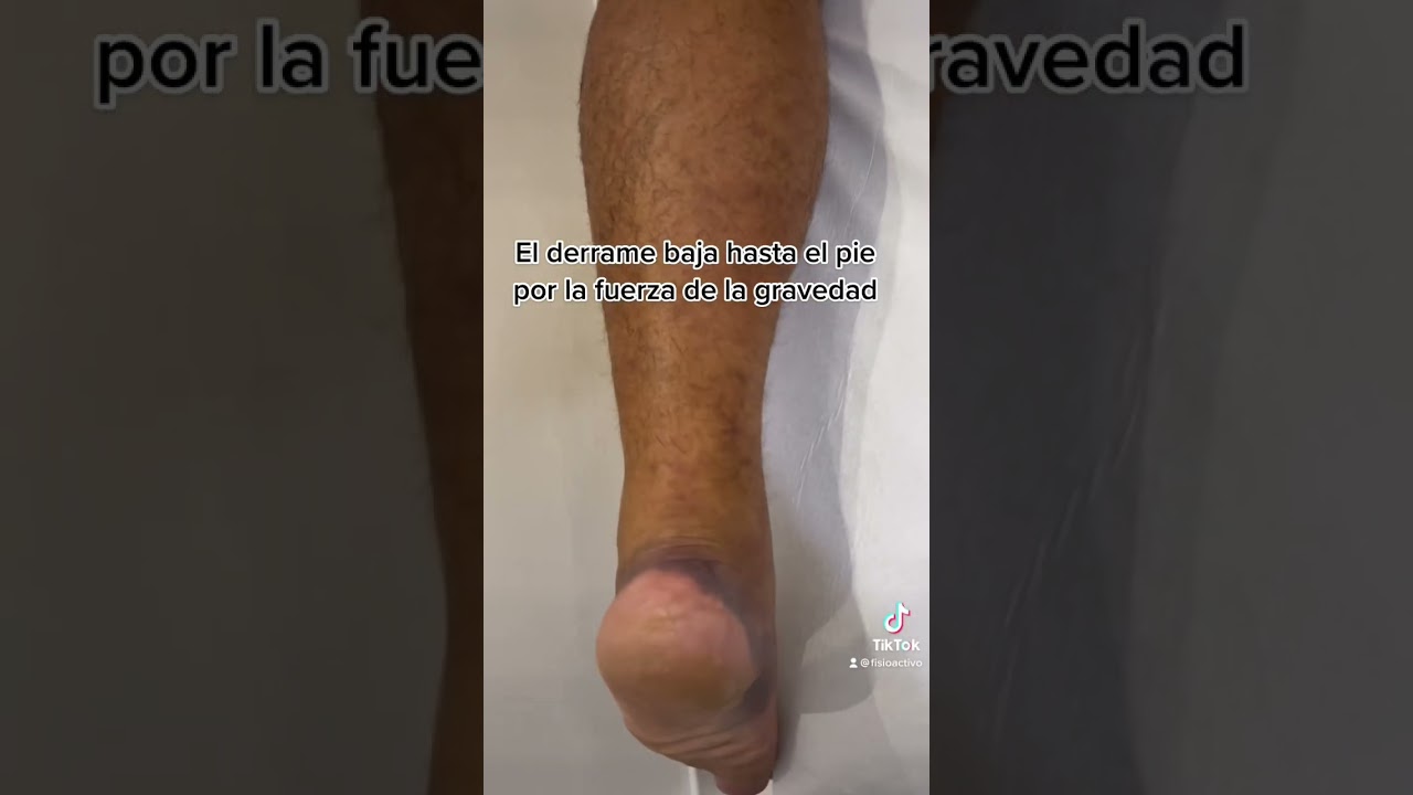 lesion muscular en el soleo tiempo de recuperacion