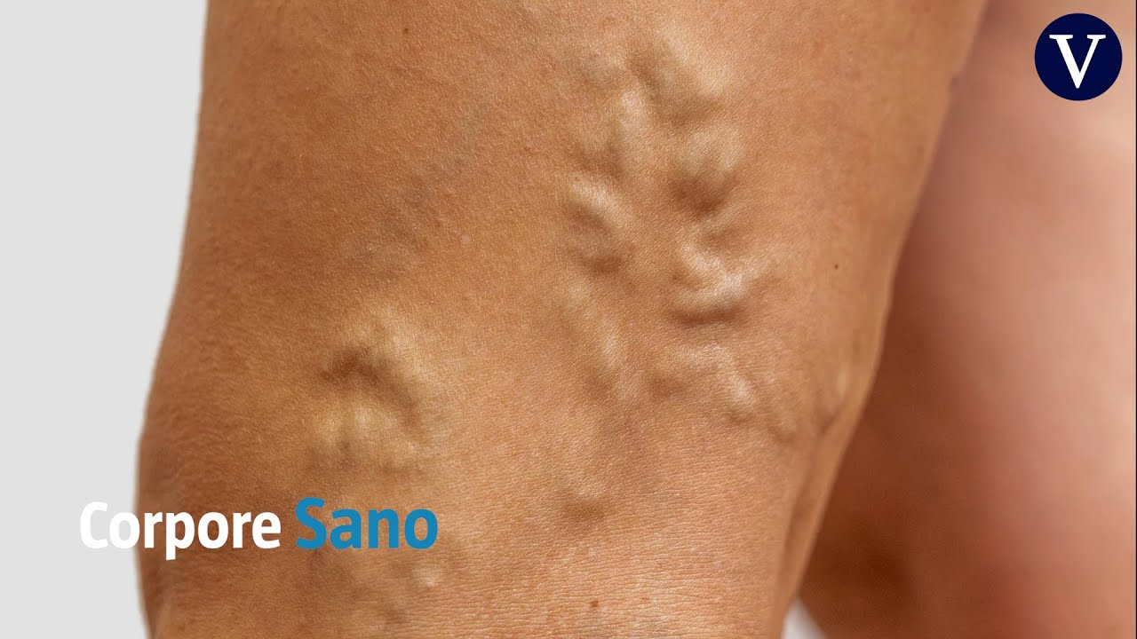 par biomagnetico para varices en piernas