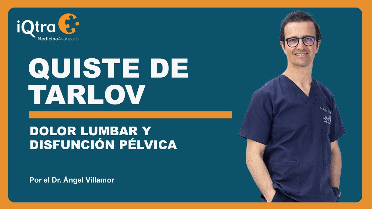 quistes de tarlov en raices lumbares y sacras