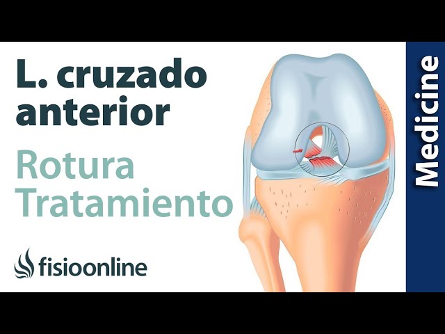 rotura del ligamento cruzado anterior de la rodilla