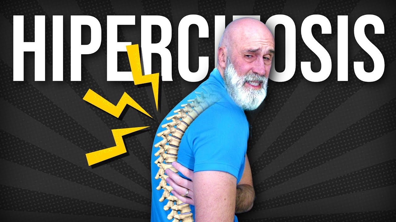 se puede corregir la cifosis en adultos