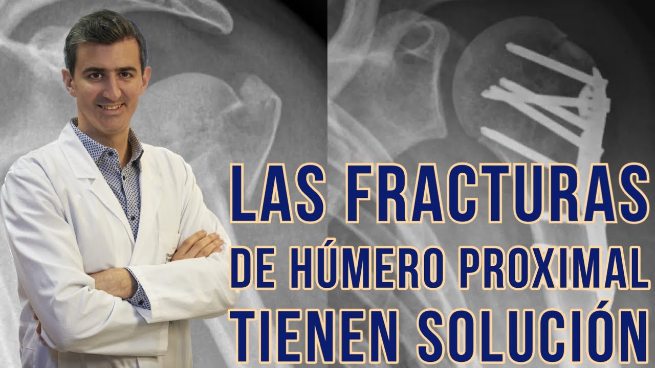 tiempo de baja por fractura de humero