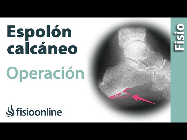 tiempo de recuperacion de operacion de fascitis plantar