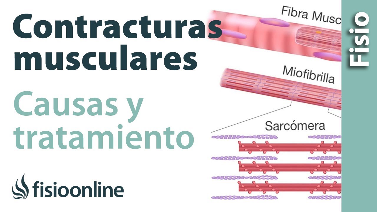 tiempo de recuperacion de una contractura