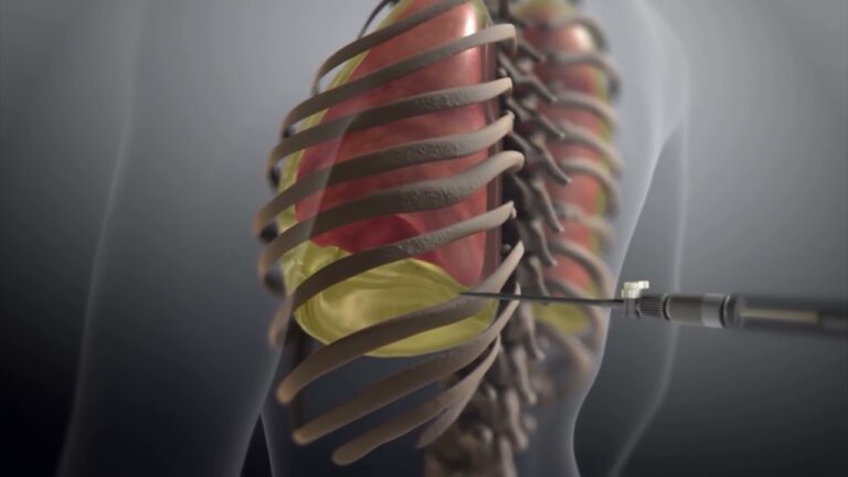 Acumulación de Pus en la Cavidad Pleural: Causas, Síntomas y