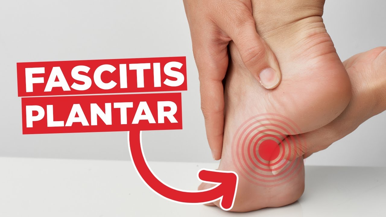 como curar una fascitis plantar del talon