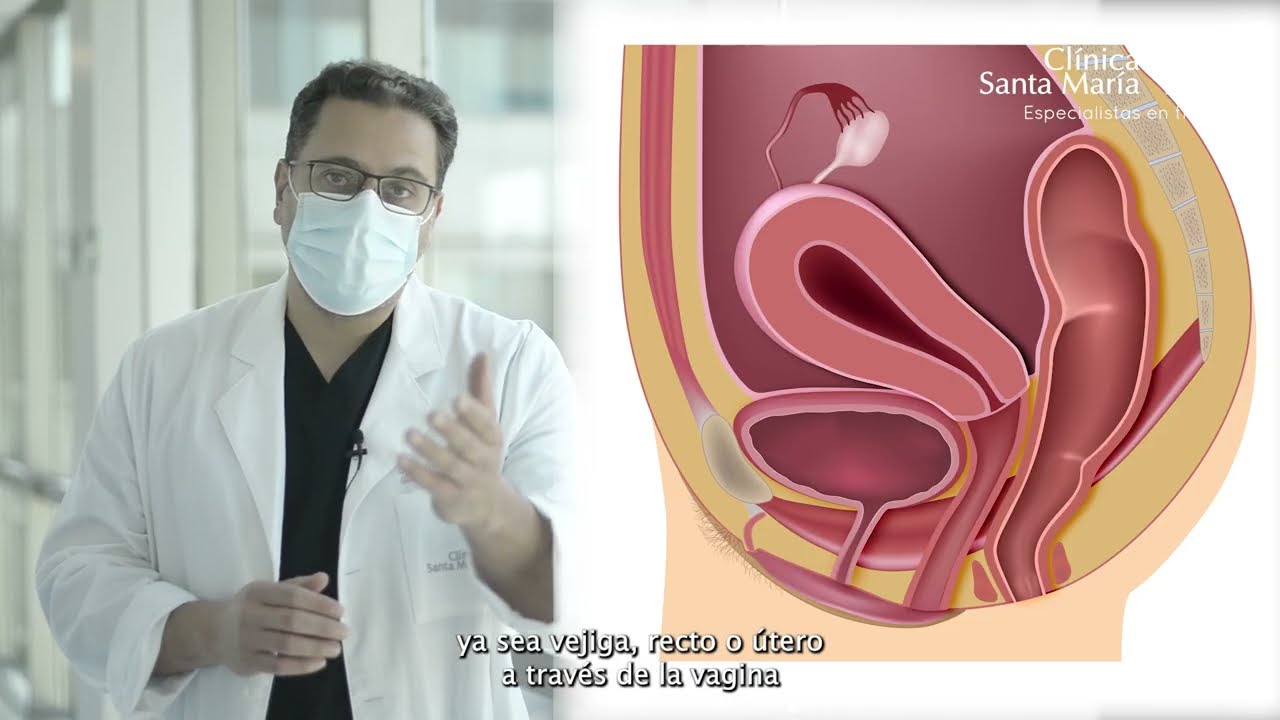 cuidados despues de una operacion de prolapso uterino