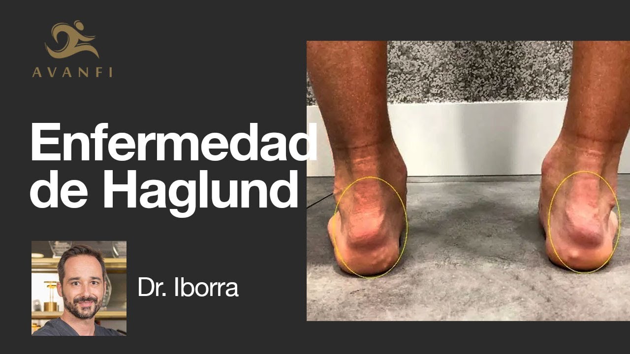 deformidad de haglund tiempo de recuperacion